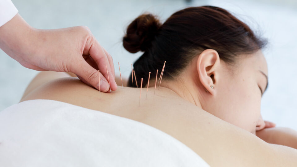 Akupunktur am Rücken